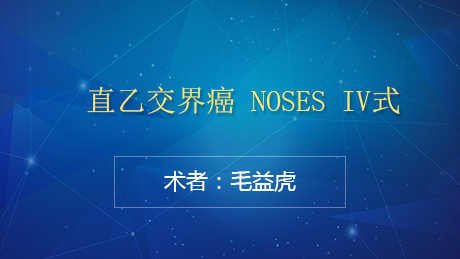 毛益虎：直乙交界癌 NOSES IV式